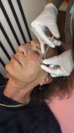 botox fac și acid hialuronic buze.jpg